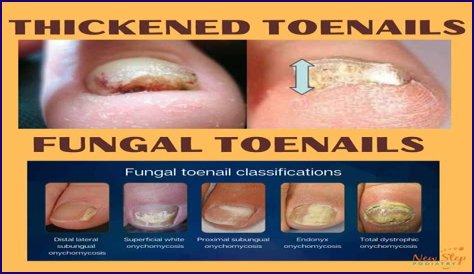 What does it mean when toenail fungus turns white?