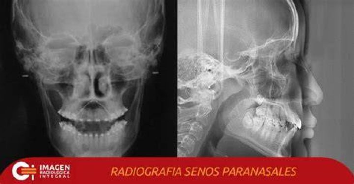 ¿Cómo se llama la radiografia de senos paranasales