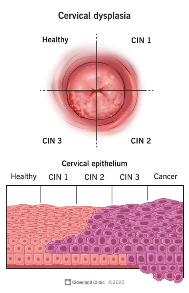 Does a friable cervix mean cancer