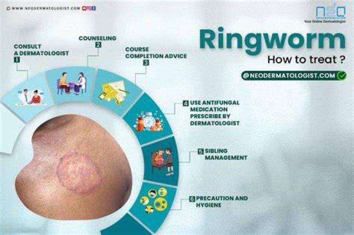 How do you treat ringworm on babies