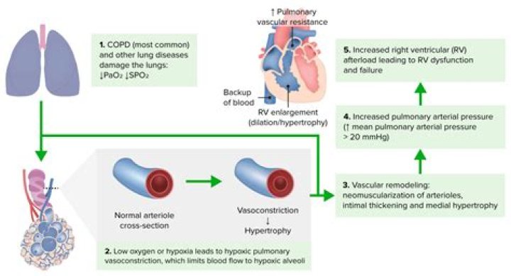How does COPD cause cor pulmonale