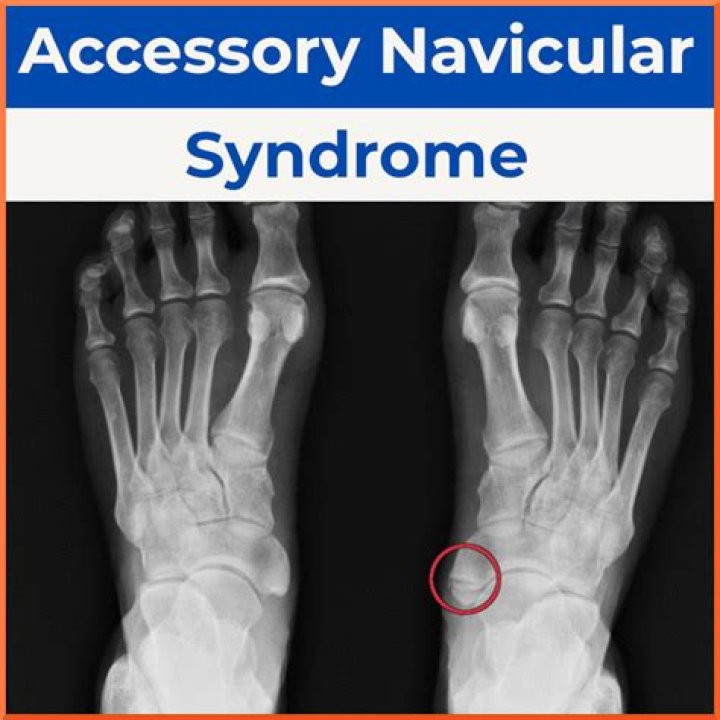 How is accessory navicular bone treated