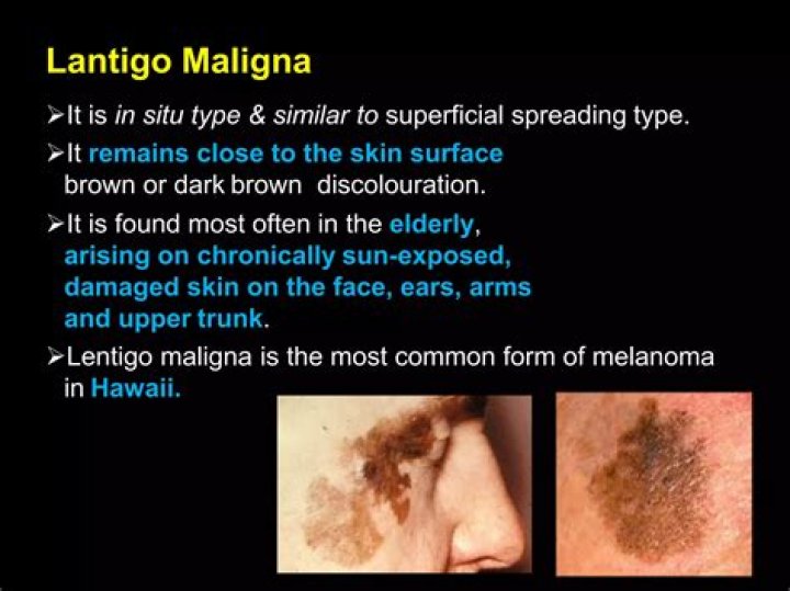 Is lentigo maligna melanoma dangerous