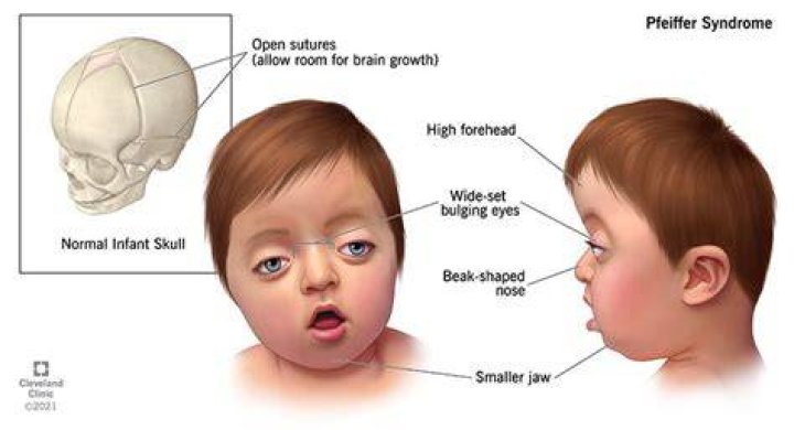 Is Pfeiffer syndrome fatal