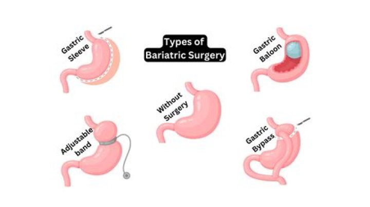 What are the stages of bariatric surgery