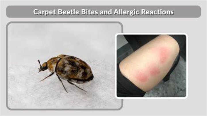 What can I put on carpet beetle bites