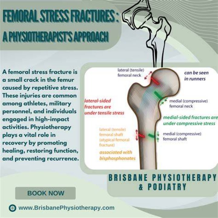 What does a femoral neck stress fracture feel like