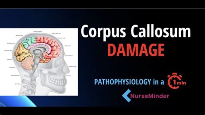 What happens when your corpus callosum is damaged