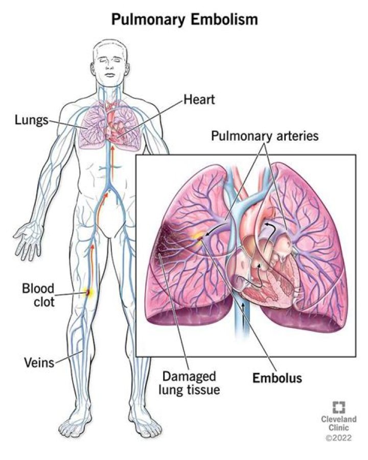 What is a massive pulmonary embolism