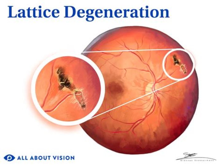 What is degeneration of the labrum