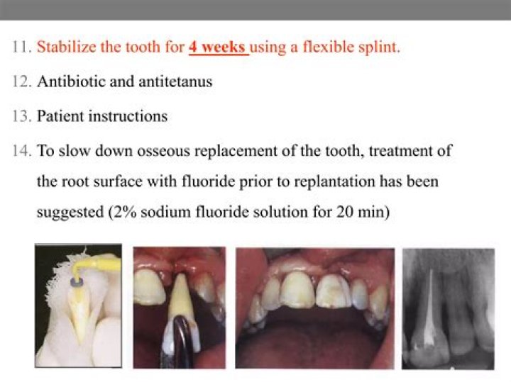 What is used to stabilize the avulsed tooth in the socket