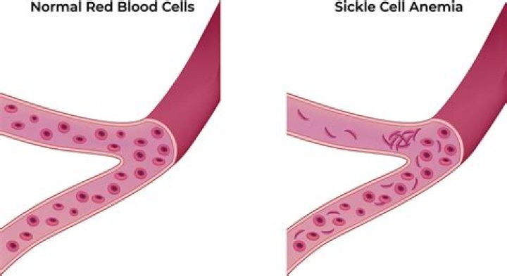 Whats the difference between anemia and sickle cell