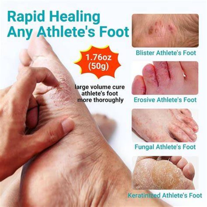 Which antifungal is best for athletes foot